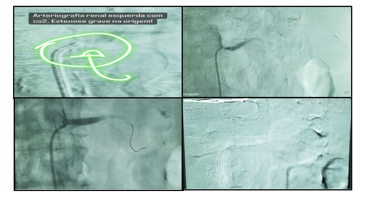 Imagens do implante do Stent na artéria renal