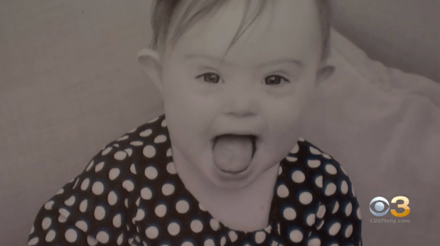 Down syndrome