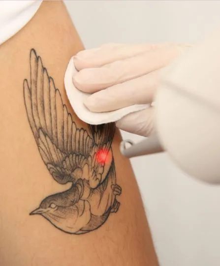 ELIMINACIÓN DE TATUAJES | beauty-gift