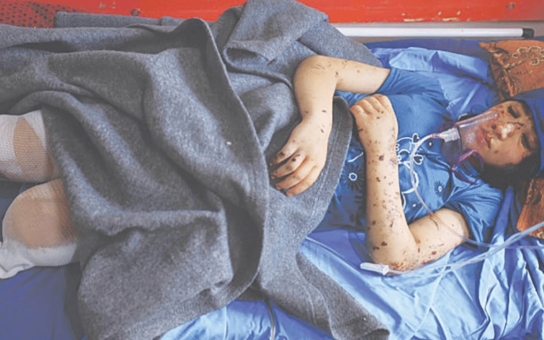 Over 1,000 Children in Gaza Have Had One or Both Legs Amputated Since Oct. 7