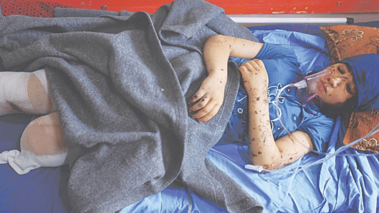 maimed child in gaza