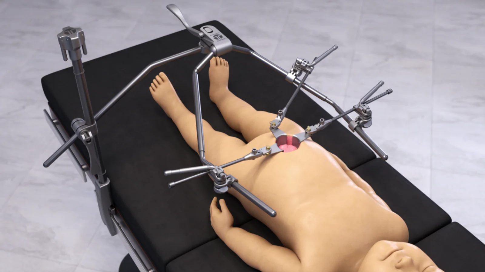 Pediatric Abdominal OneFrame Retractor Set