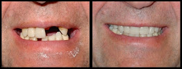 Parisien Denture Clinic Windsor (Full, Partial, Implants, Repairs, Relines, and Whitening)