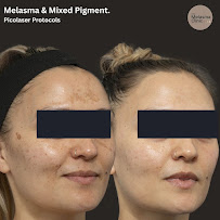 Uptown Skin & Laser Clinic – Morpheus8, Melasma, Hair Removal & Facial Spa Surrey & White Rock