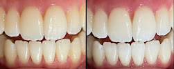 Power Bright Canada Teeth Whitening