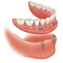 Alliston Denture Clinic