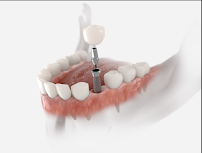 Denturos d'ici - Denturologiste Chicoutimi