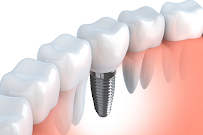 Upper Thornhill Dental Care