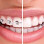 Exeter Smiles Braces & Invisalign in Reading