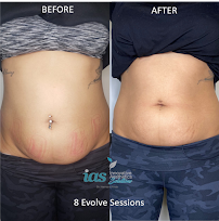 resurFACE Skin Rejuvenation