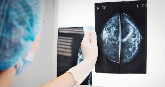 Research reveals how fat cells can have fuels of breast cancer tumors

star-news.press/wp